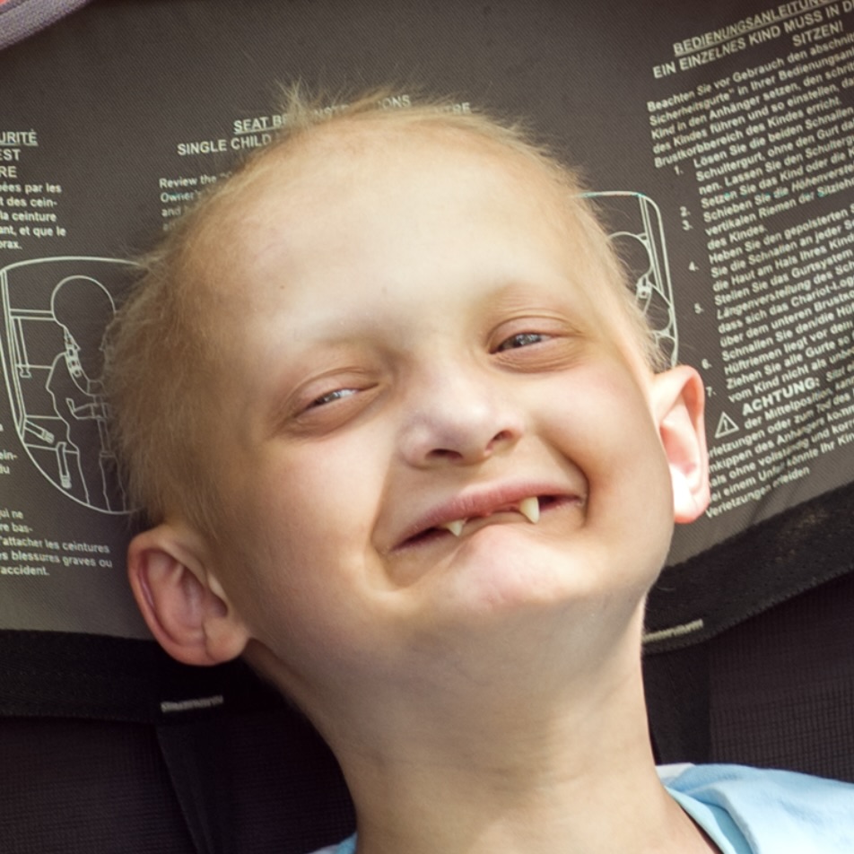 Foto eines Jungen mit X-chromosomaler hypohidrotischer Dysplasie.